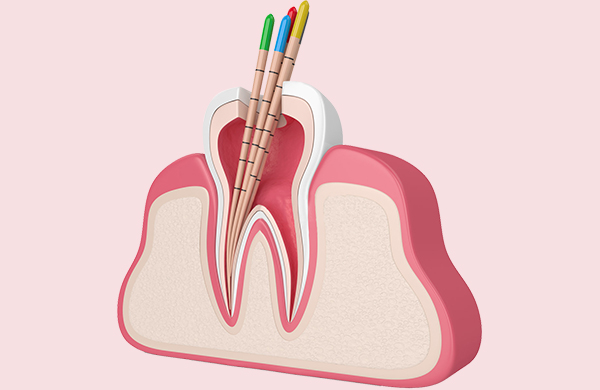 根管治療